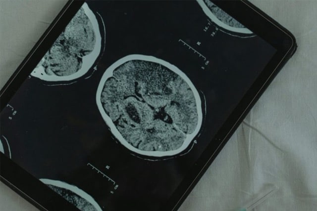 Doenças Cerebrovasculares (AVC)