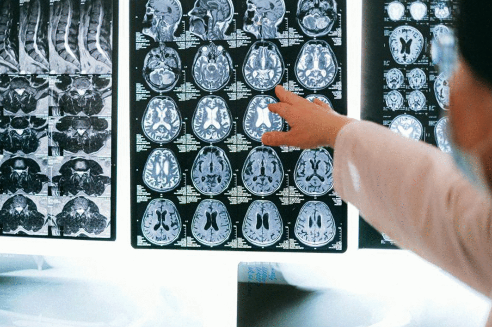 Neuroinfecções