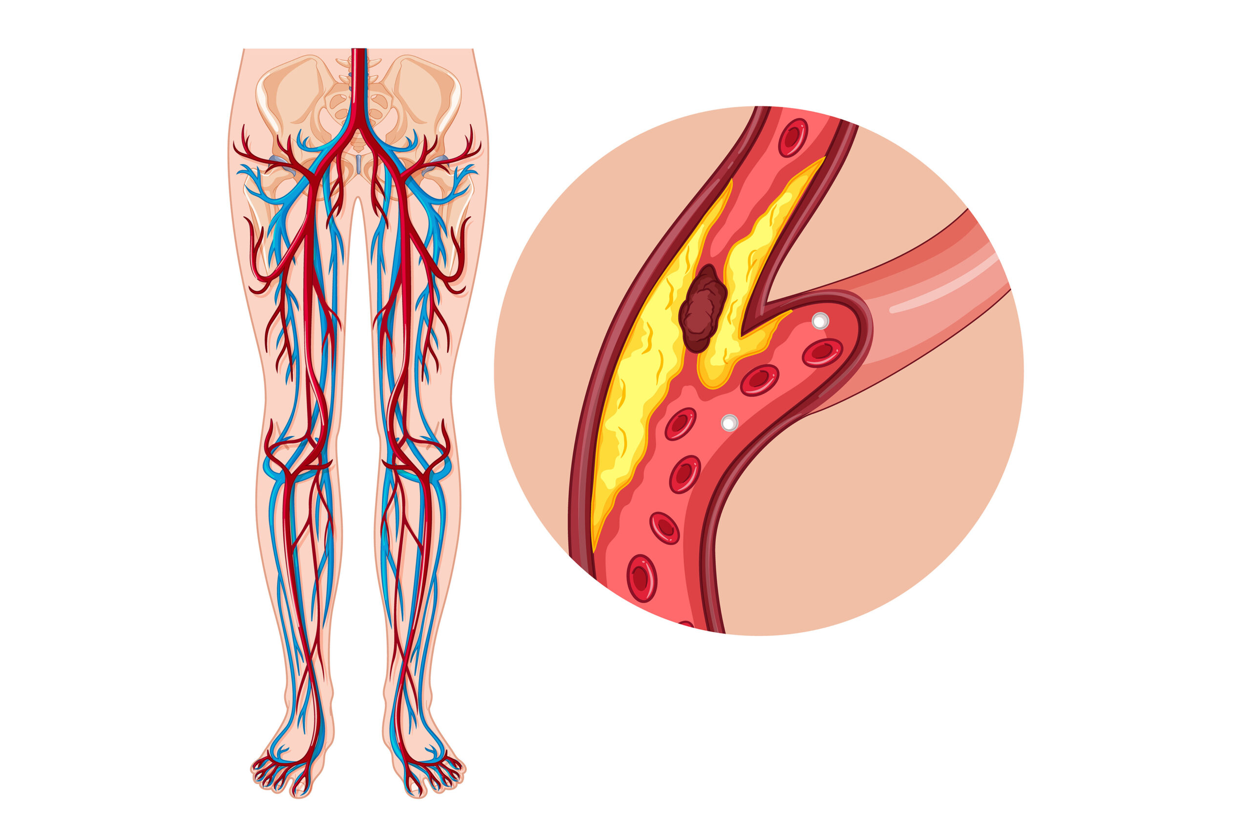 Doenças arteriais periféricas