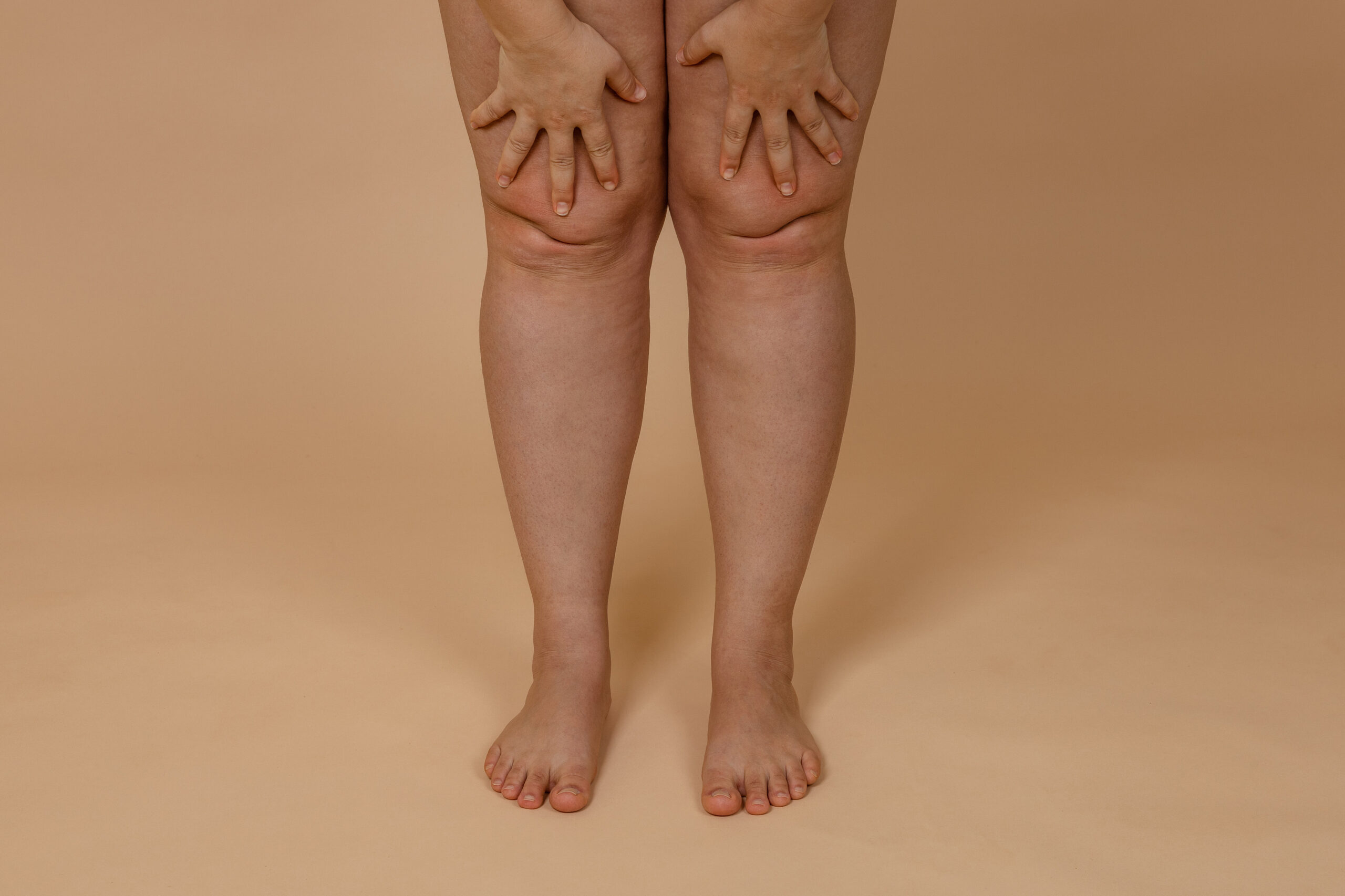 Linfedema e Lipedema